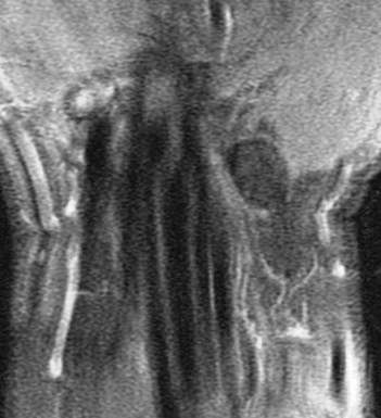 Figure 4 for case trapezial tubercle fracture ( RID2193 )